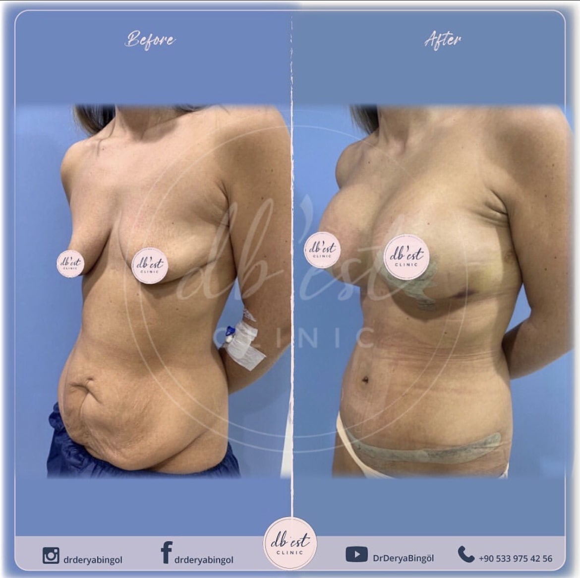 TummyTuckBreast-Uplift-with-Silicone-min