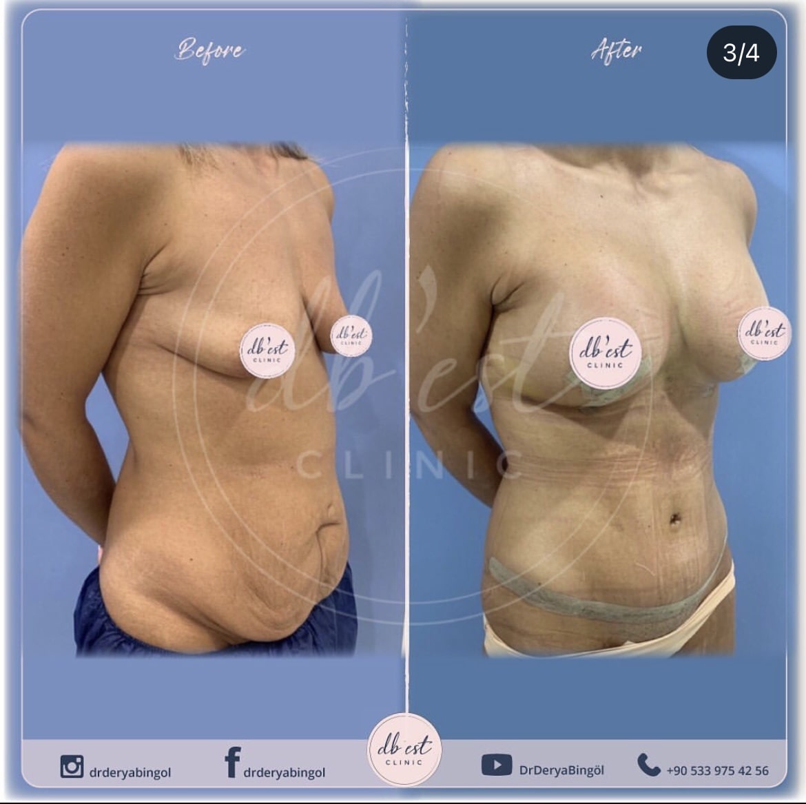 TummyTuckBreast-Uplift-with-Silicone1-min-1