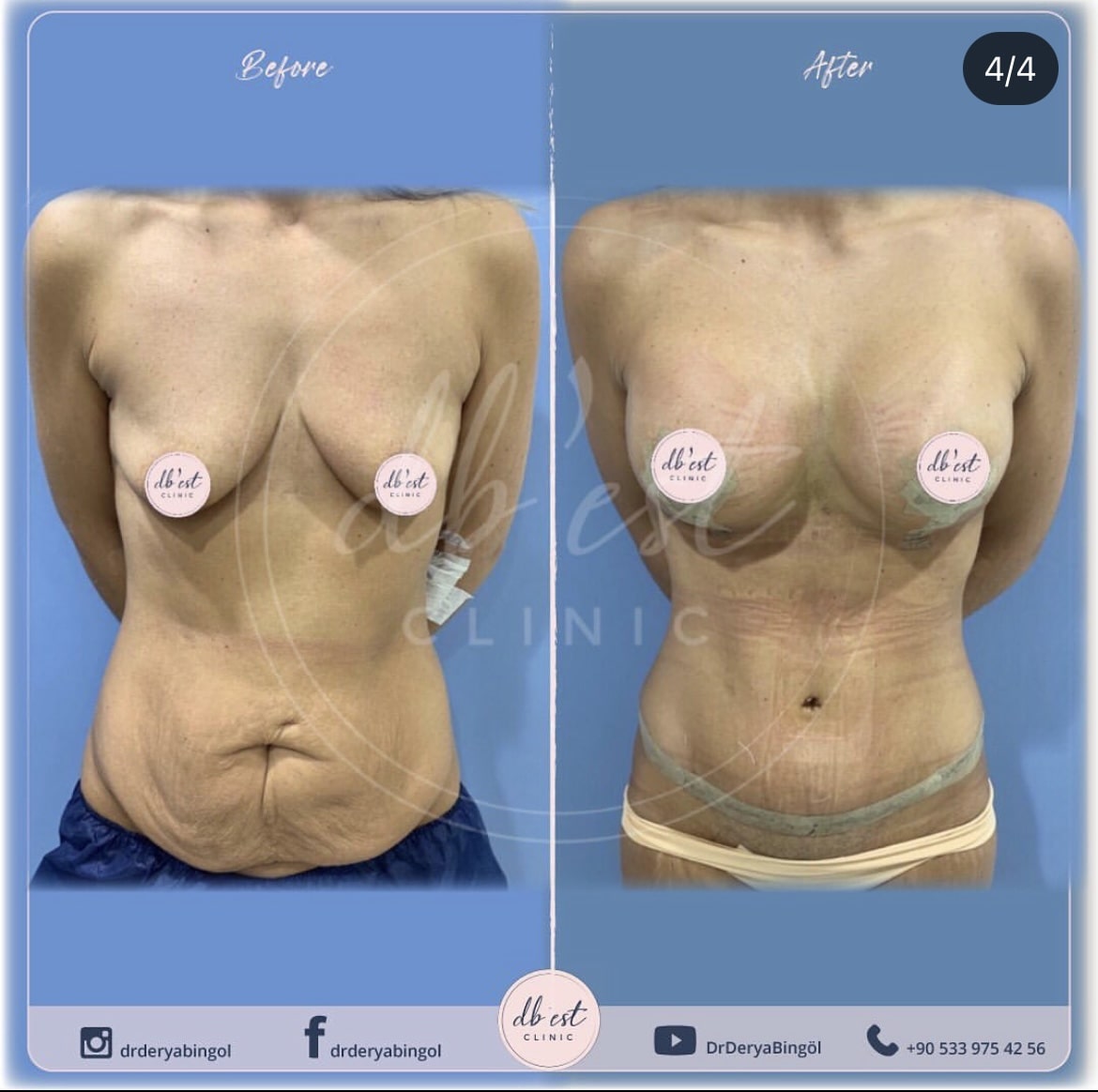 TummyTuckBreast-Uplift-with-Silicone2-min