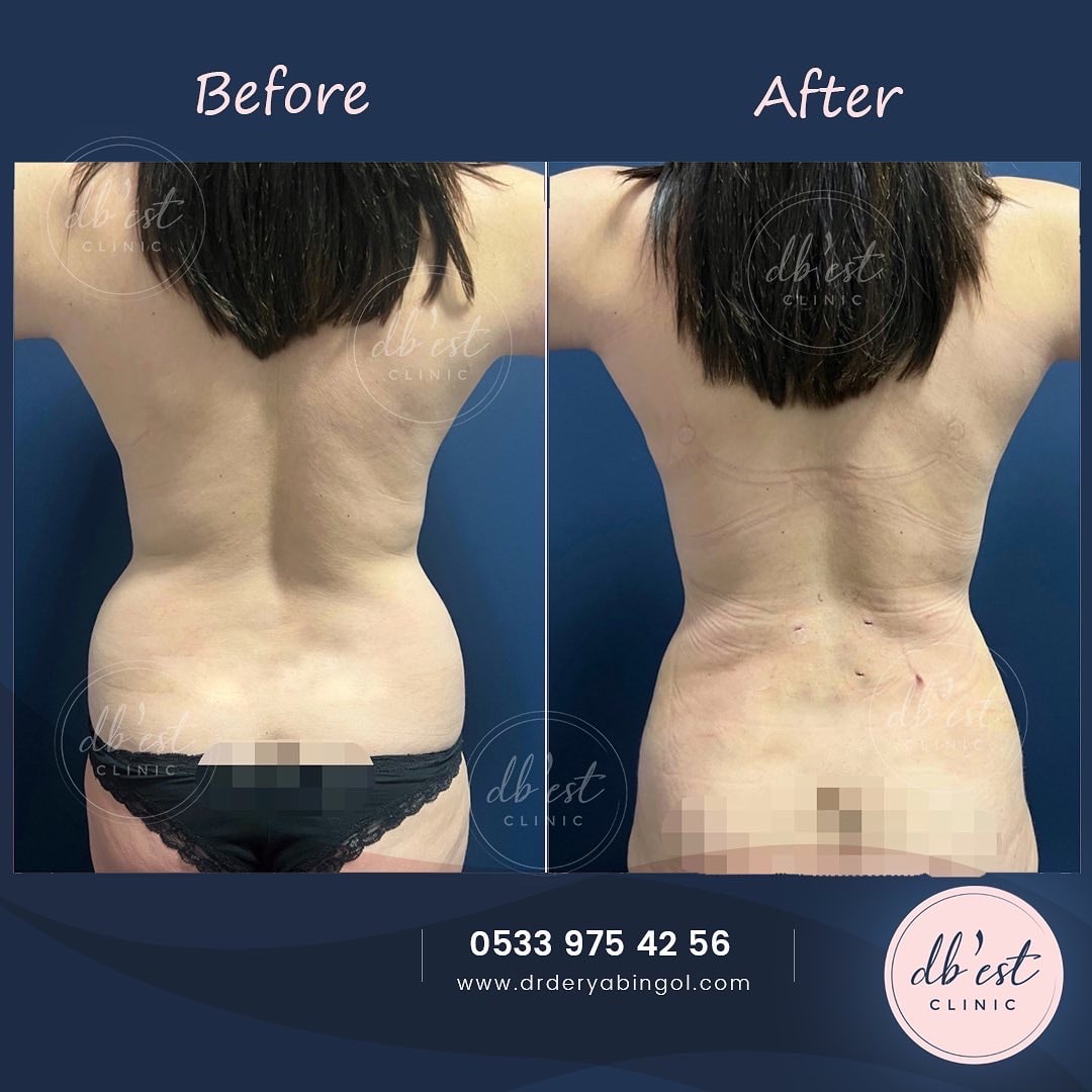 tummytuckVaserLipo-min