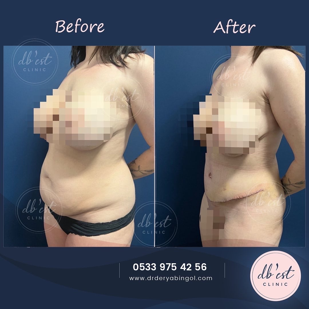 tummytuckVaserLipo1-min