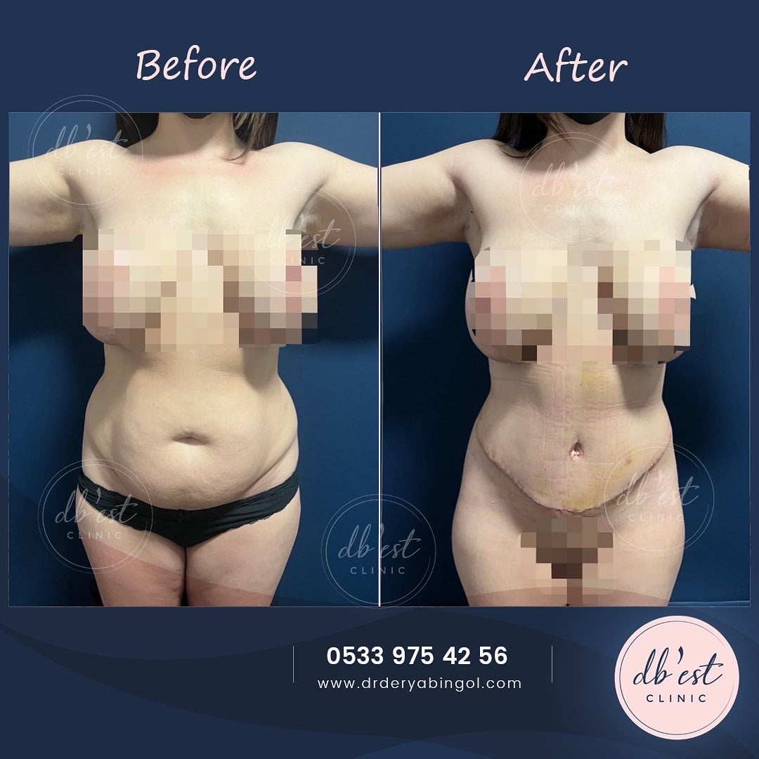 tummytuckVaserLipo2-min