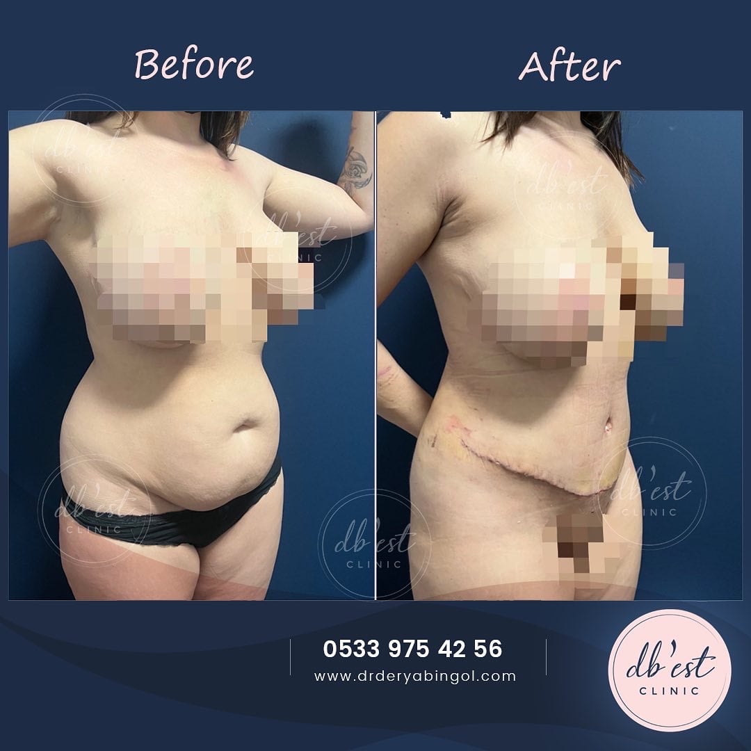 tummytuckVaserLipo3-min